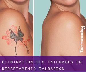 Élimination des tatouages en Departamento d'Albardón