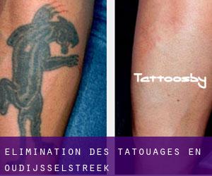 Élimination des tatouages en Oud'IJsselstreek